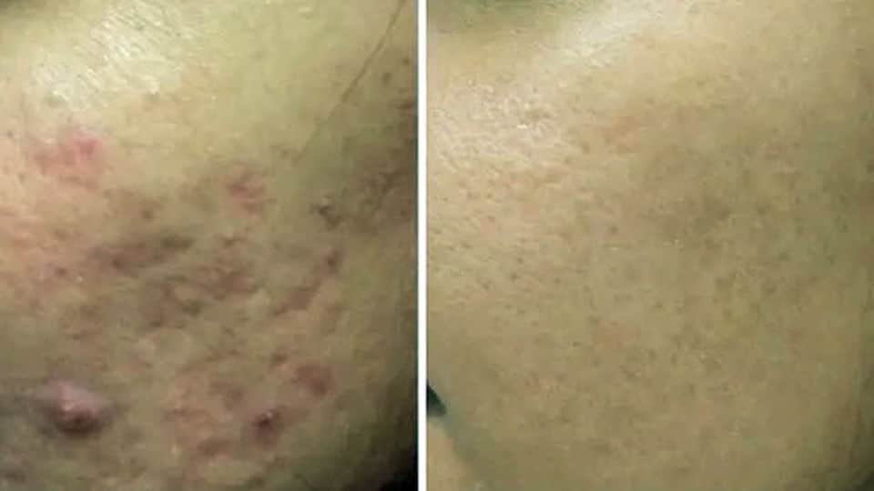 Scar Reduction