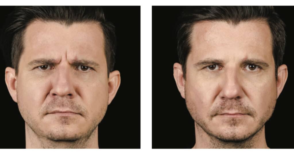 Line Relaxer treatment for men