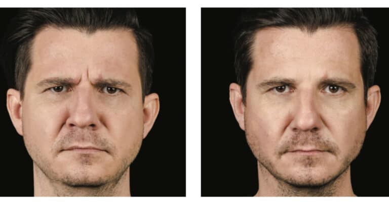 Line Relaxer treatment for men