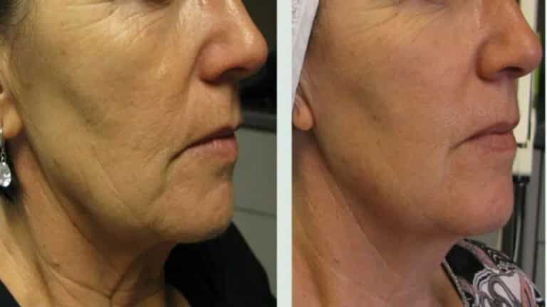 Skin Tighten and Rejuvenation - 4 Treatments