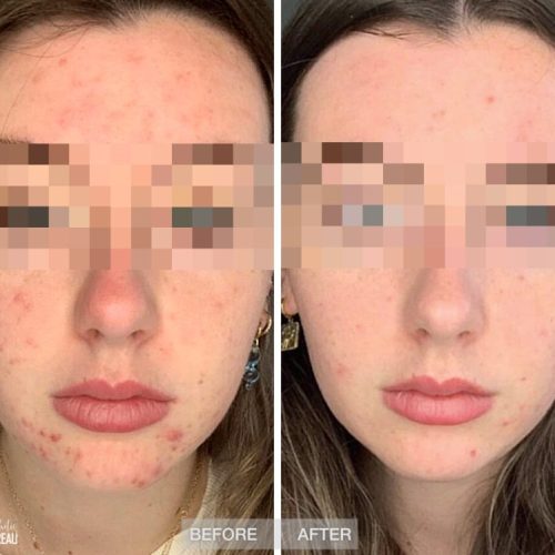 Before-After-Beauty-Boyce-Acne