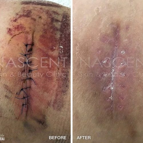 Before-After-Nascent-Wound-Healing-Xen-1