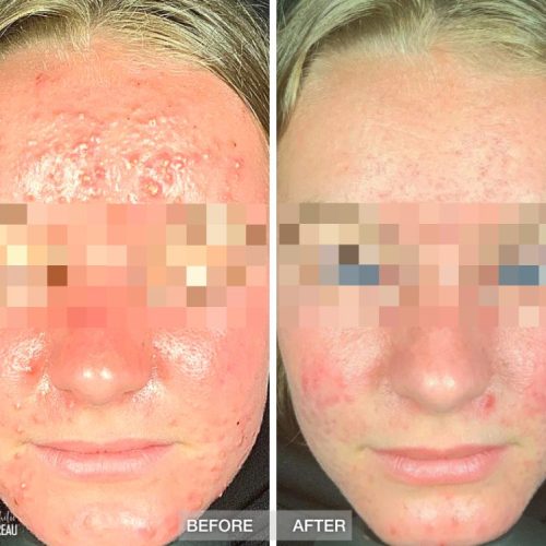 Before-After-Thistle-Rose-Acne