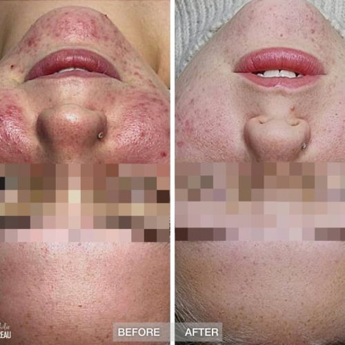 Before-after-Bare-Bella-Acne-Xen