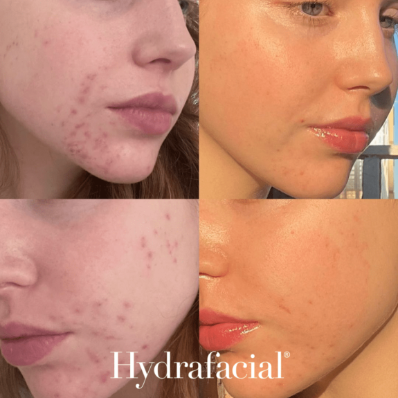 Hydrafacial Before and After 1 with logo