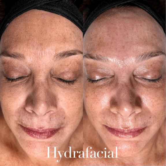 Hydrafacial Before and After 2 with logo