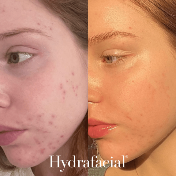 Hydrafacial Before and After 3 with logo