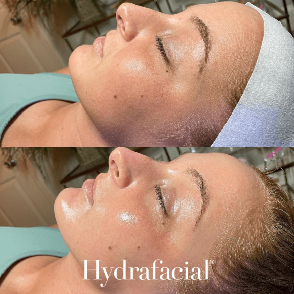 Hydrafacial Before and After 4 with logo